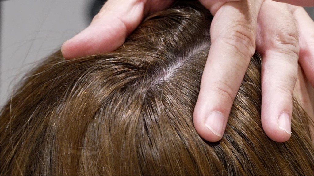¿Alopecia? En Jesús Dos le ayudamos
