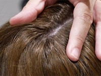 ¿Alopecia? En Jesús Dos le ayudamos