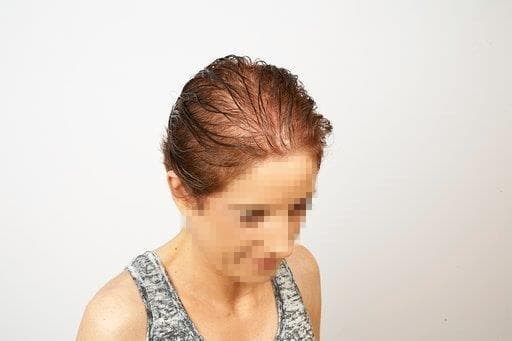 Alopecia post-menopáusica - Imagen 1