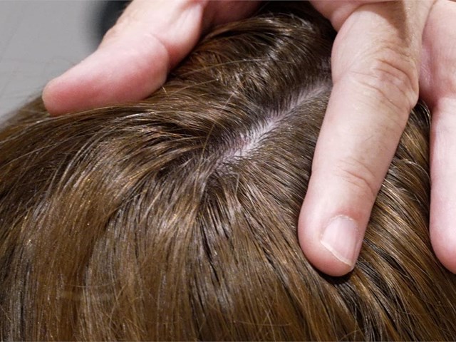 ¿Cuánto cuesta una prótesis capilar en Vigo?