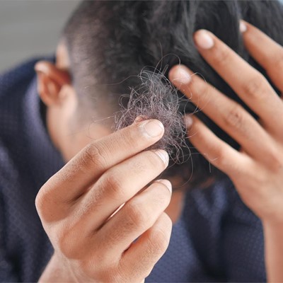 Diagnóstico y tratamiento de alopecia fibrosante frontal