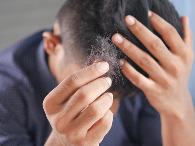 Diagnóstico y tratamiento de alopecia fibrosante frontal