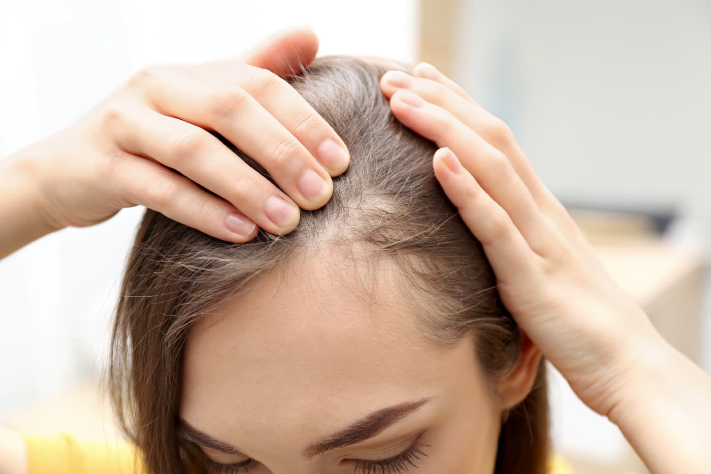 Caída del pelo, tratamiento en Jesús Dos