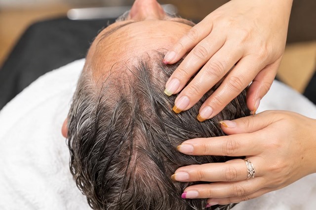 Pare la caída del cabello con un diagnóstico capilar en Vigo - Imagen 1